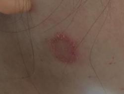 人得了猫癣是什么症状？猫藓会传染到人身上吗照片