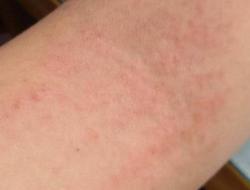 成人痱子应该怎么治疗？成年人痱子到底应该如何治疗呢？