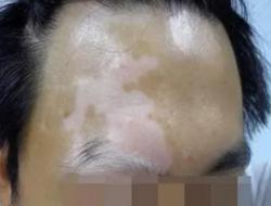 白癜风能治好吗？白癜风终于治好了的方法