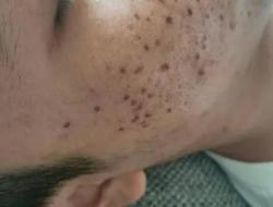 痤疮能不能自己恢复吗